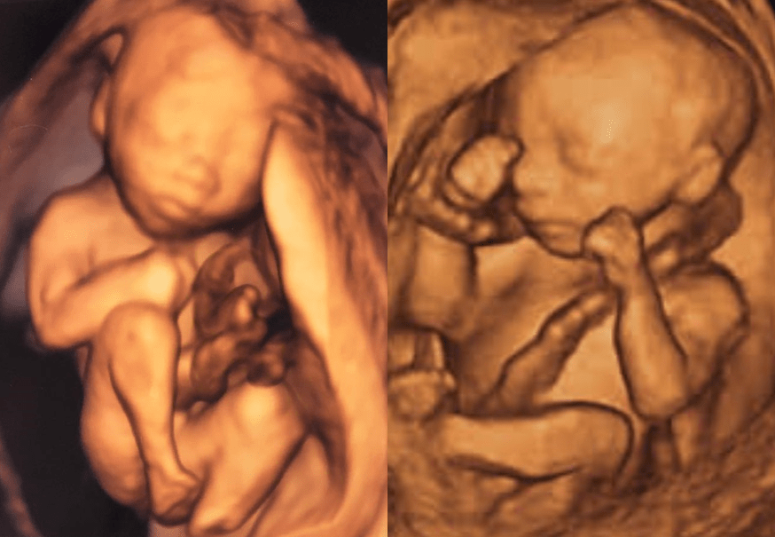 Rape or Love Ultrasound Comparison