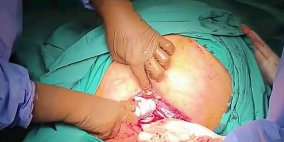 Baby grasps the hand of surgeon during caesarian section